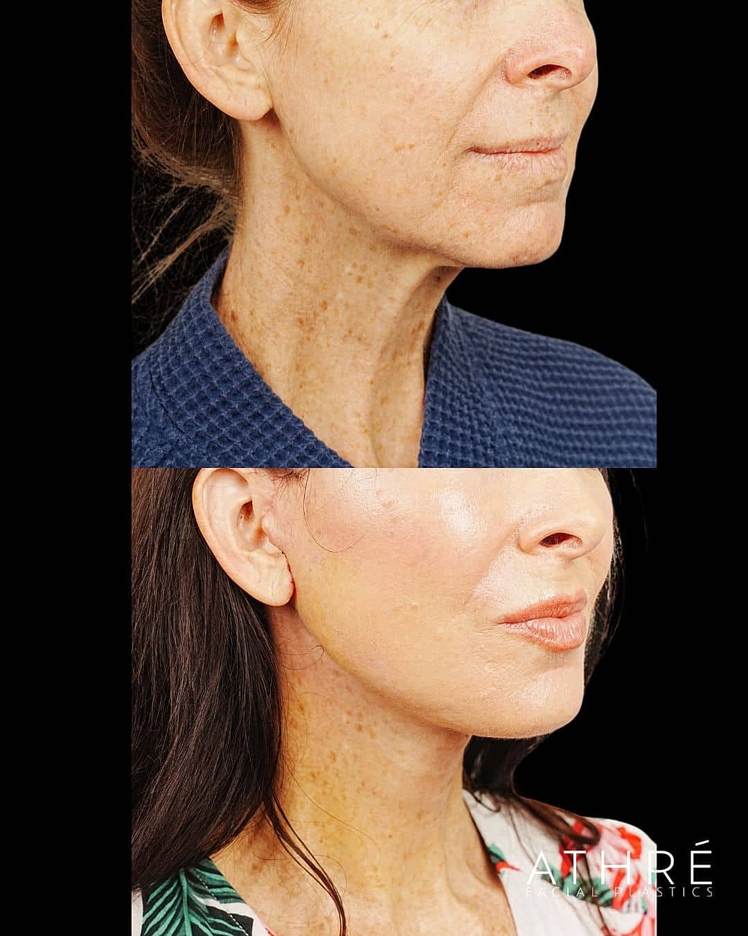 Before and after facial treatment comparison image.