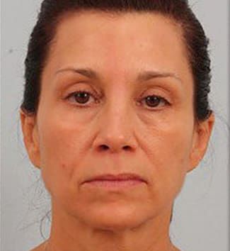 Neck Lift Before & After