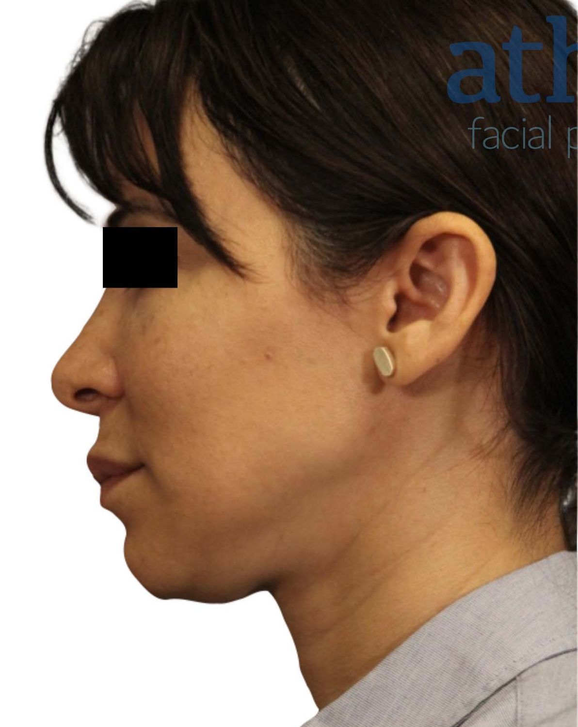 Neck Lift Before & After