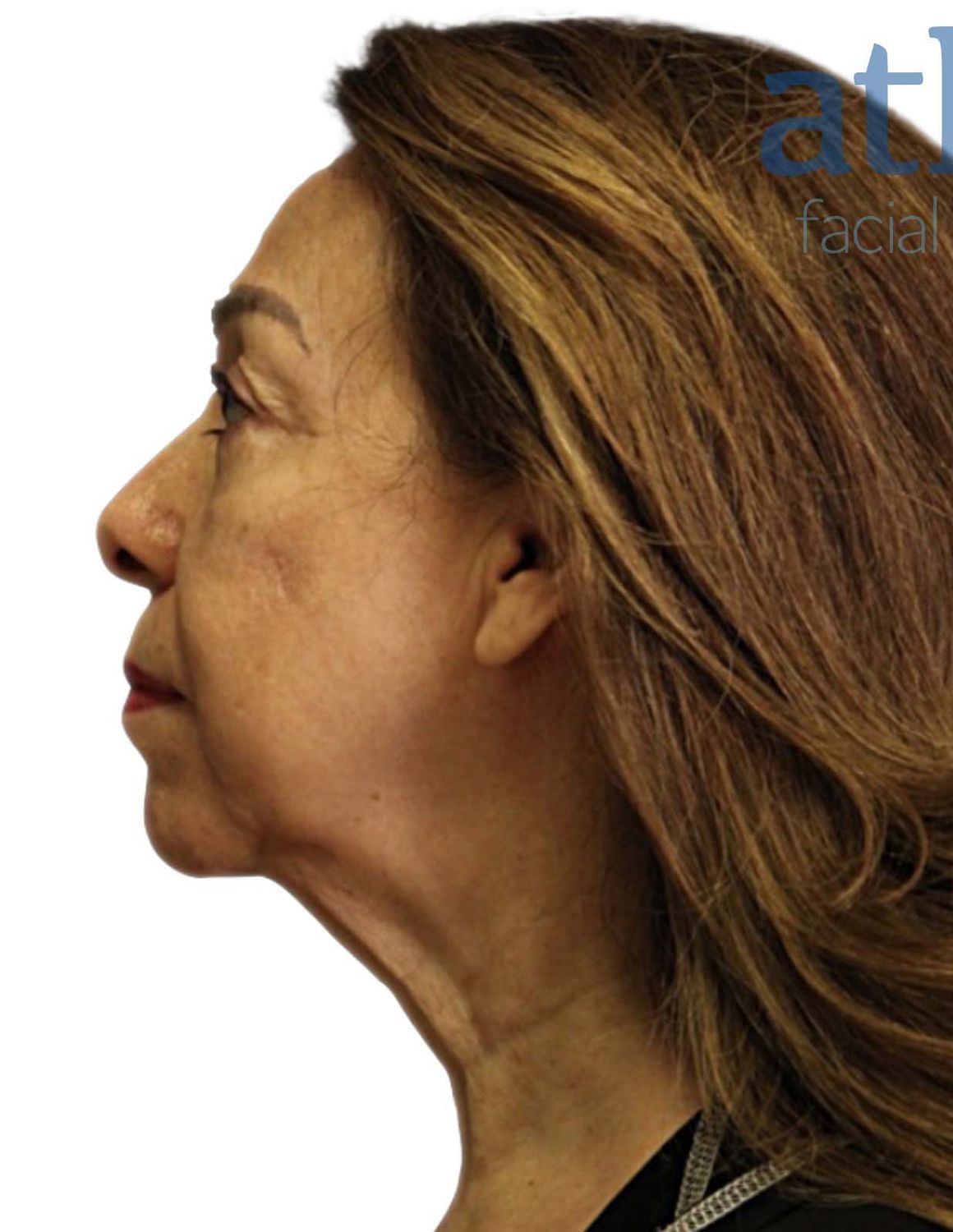 Neck Lift Before & After