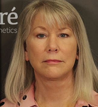 Neck Lift Before & After