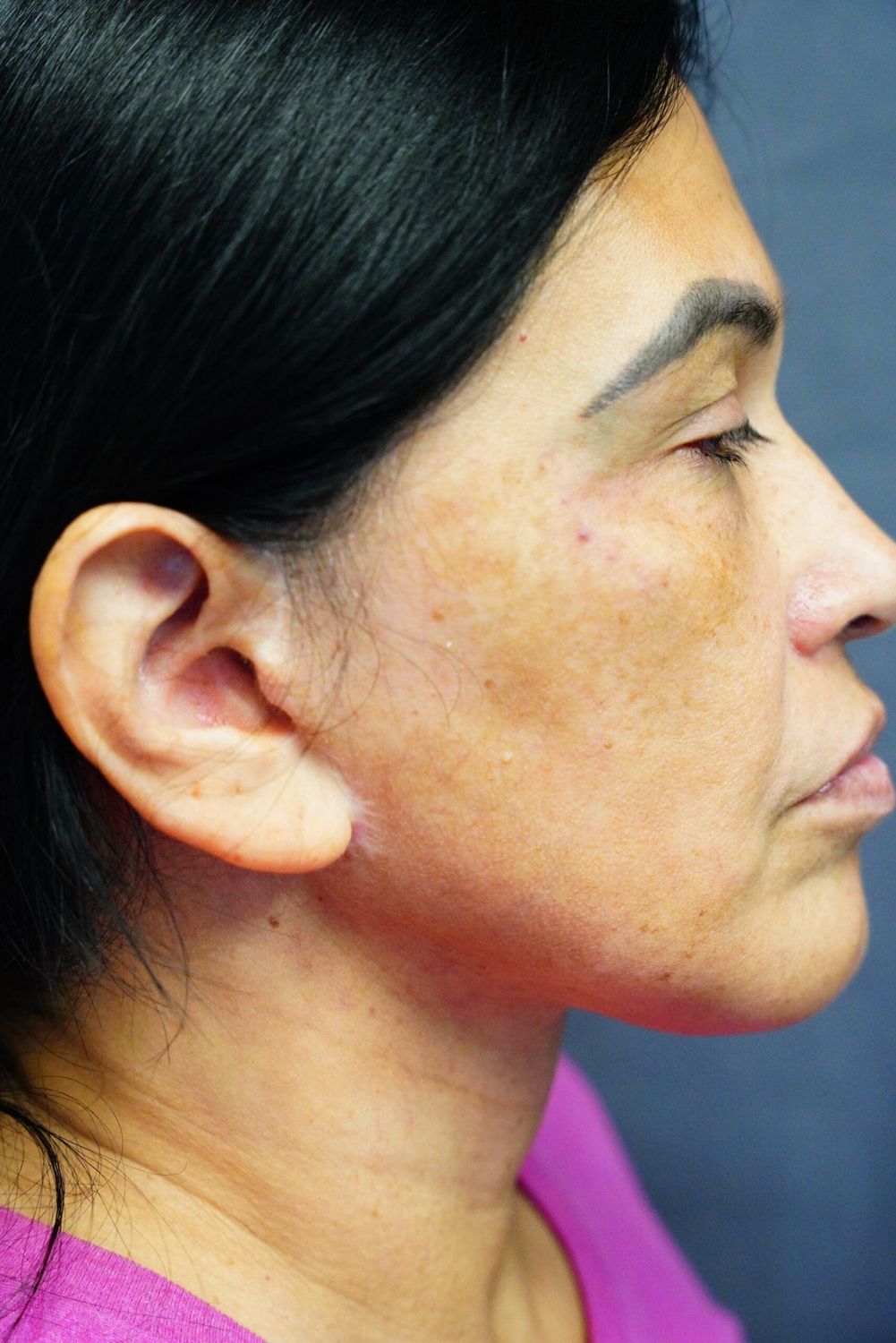 Neck Lift Before & After