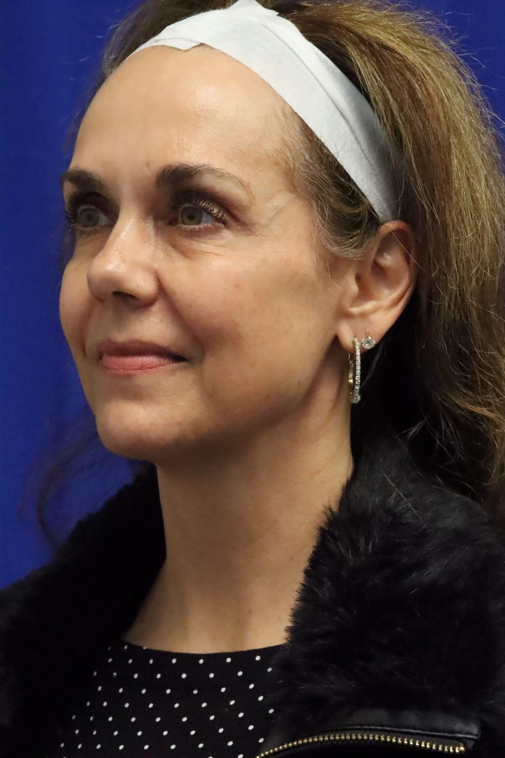 Neck Lift Before & After