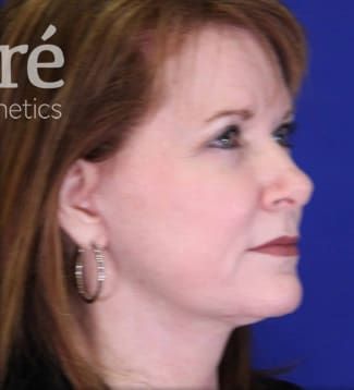 Neck Lift Before & After