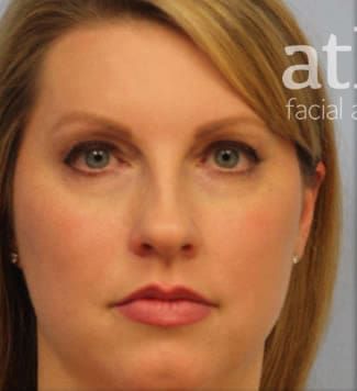 Neck Lift Before & After