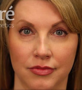 Neck Lift Before & After