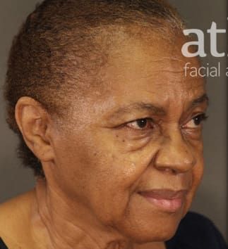 Neck Lift Before & After