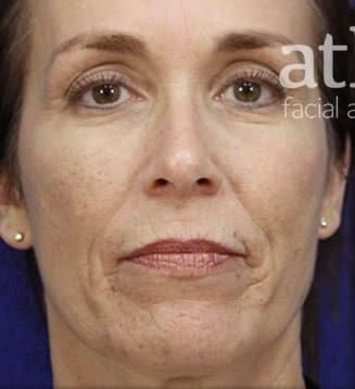 Neck Lift Before & After