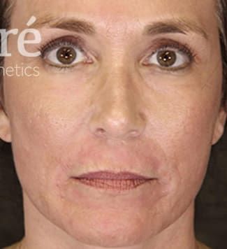 Neck Lift Before & After