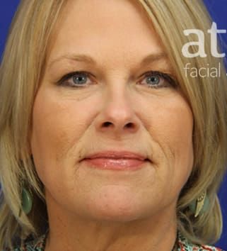 Neck Lift Before & After