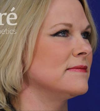 Neck Lift Before & After