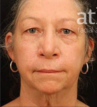 Neck Lift Before & After