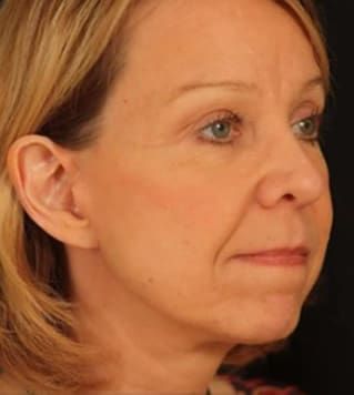 Neck Lift Before & After