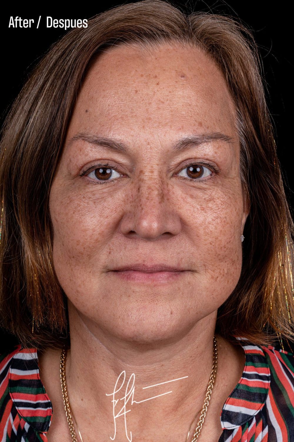 Neck Lift Before & After