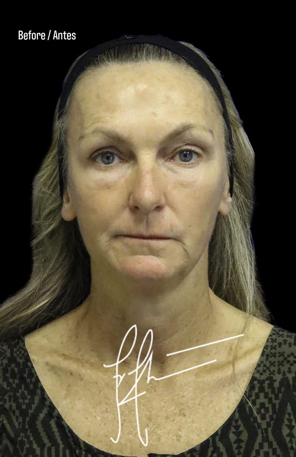 Neck Lift Before & After