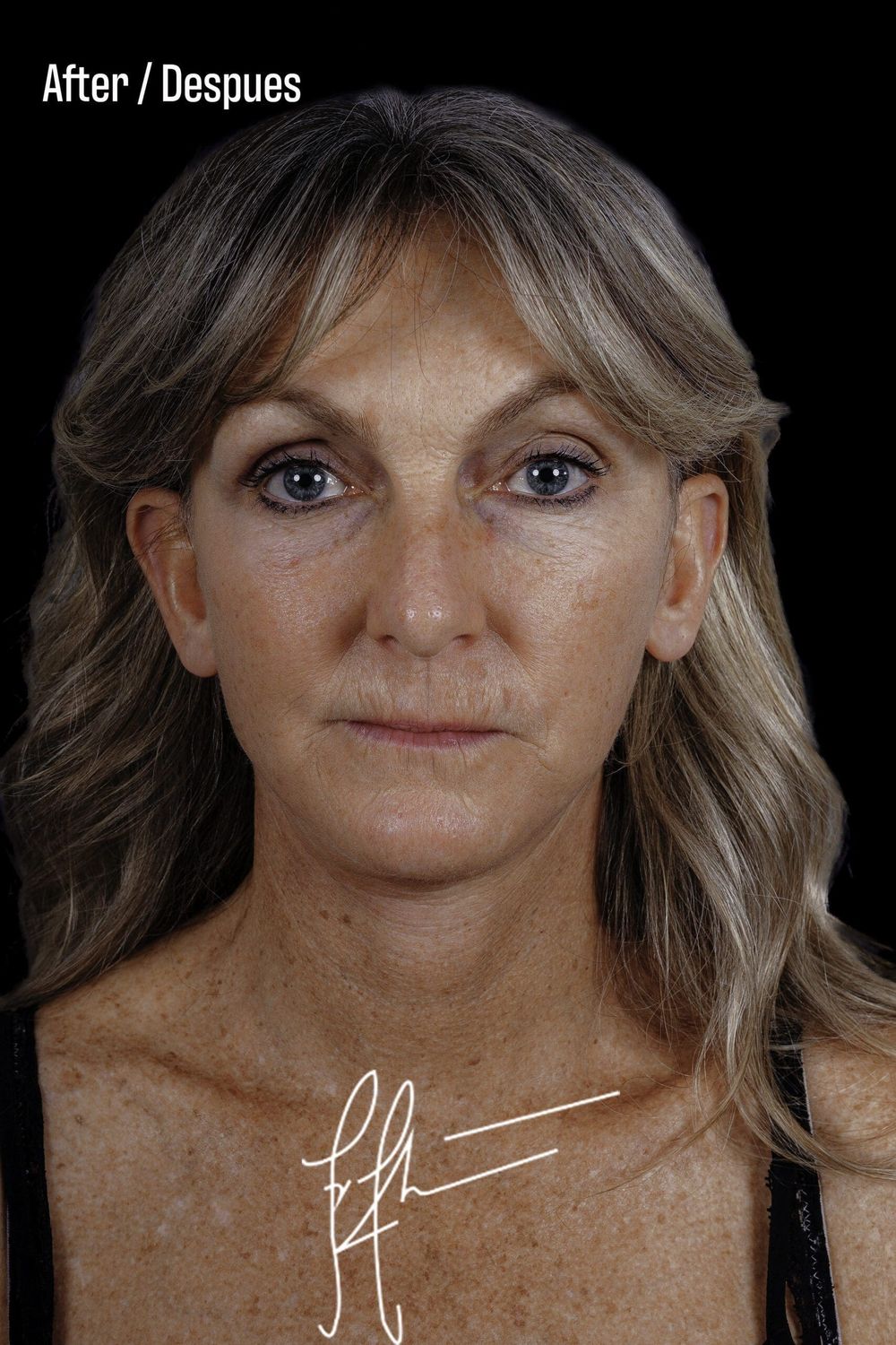 Neck Lift Before & After