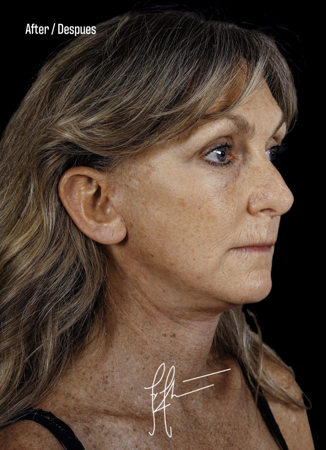 Neck Lift Before & After