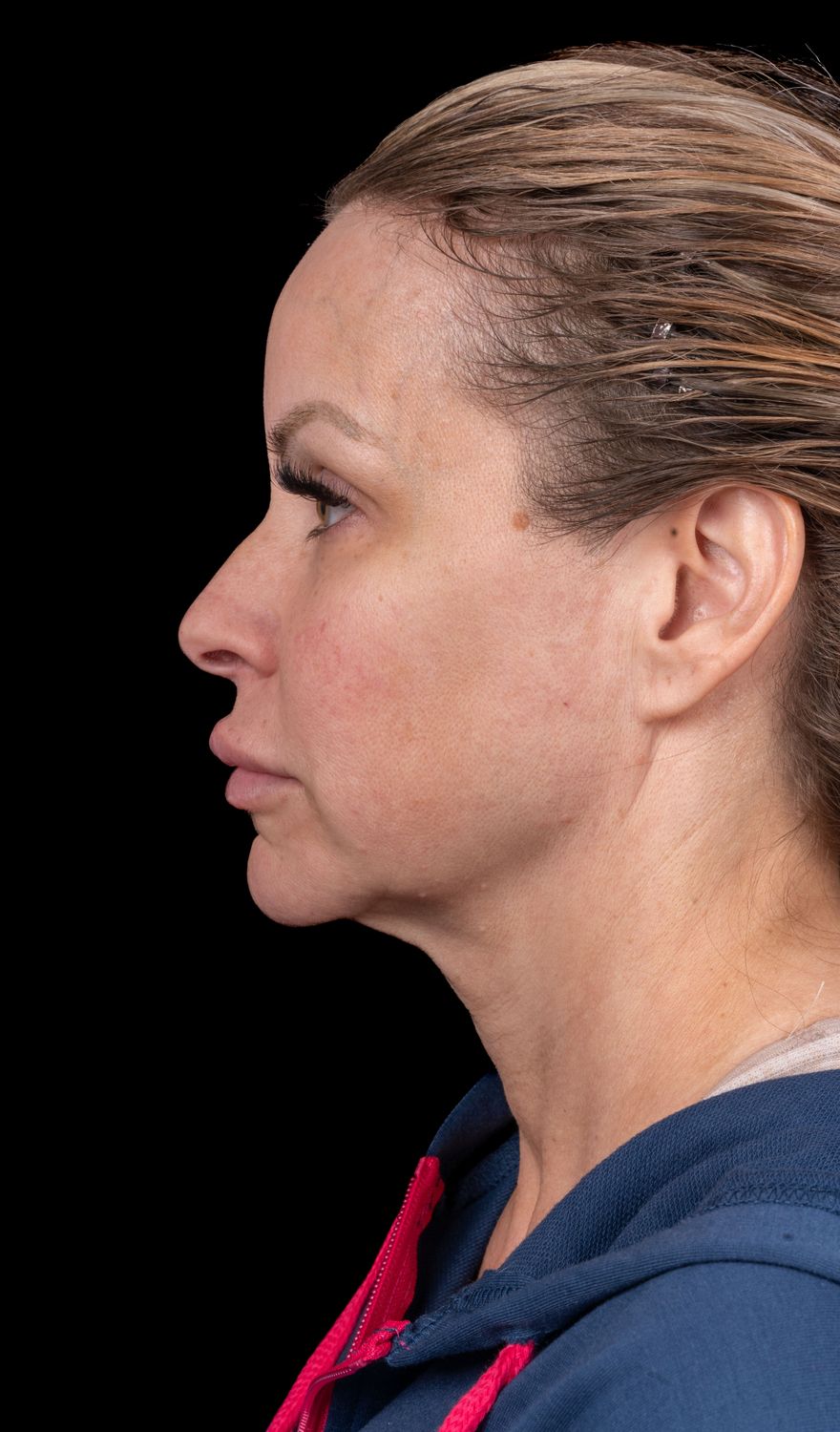 Neck Lift Before & After