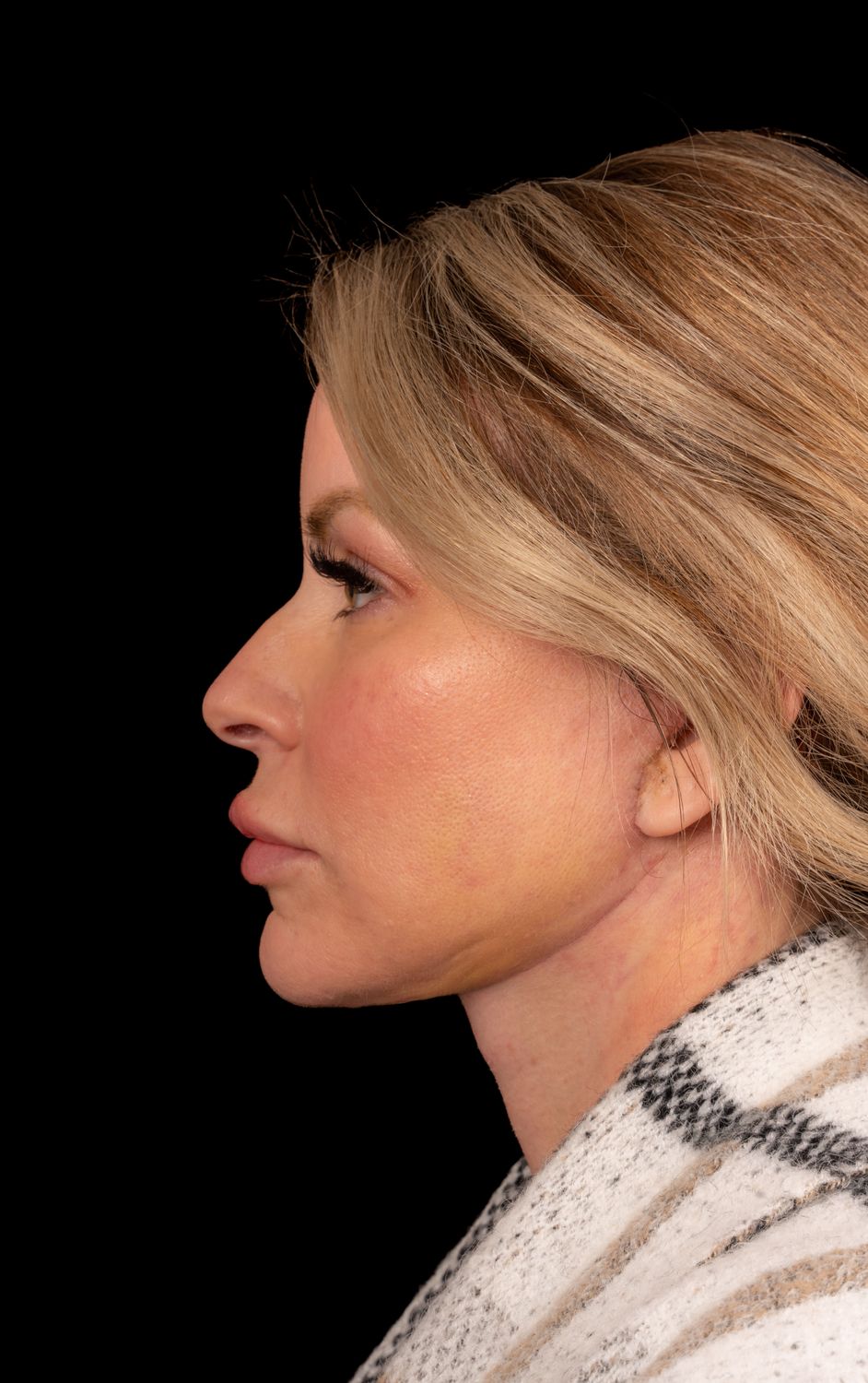 Neck Lift Before & After