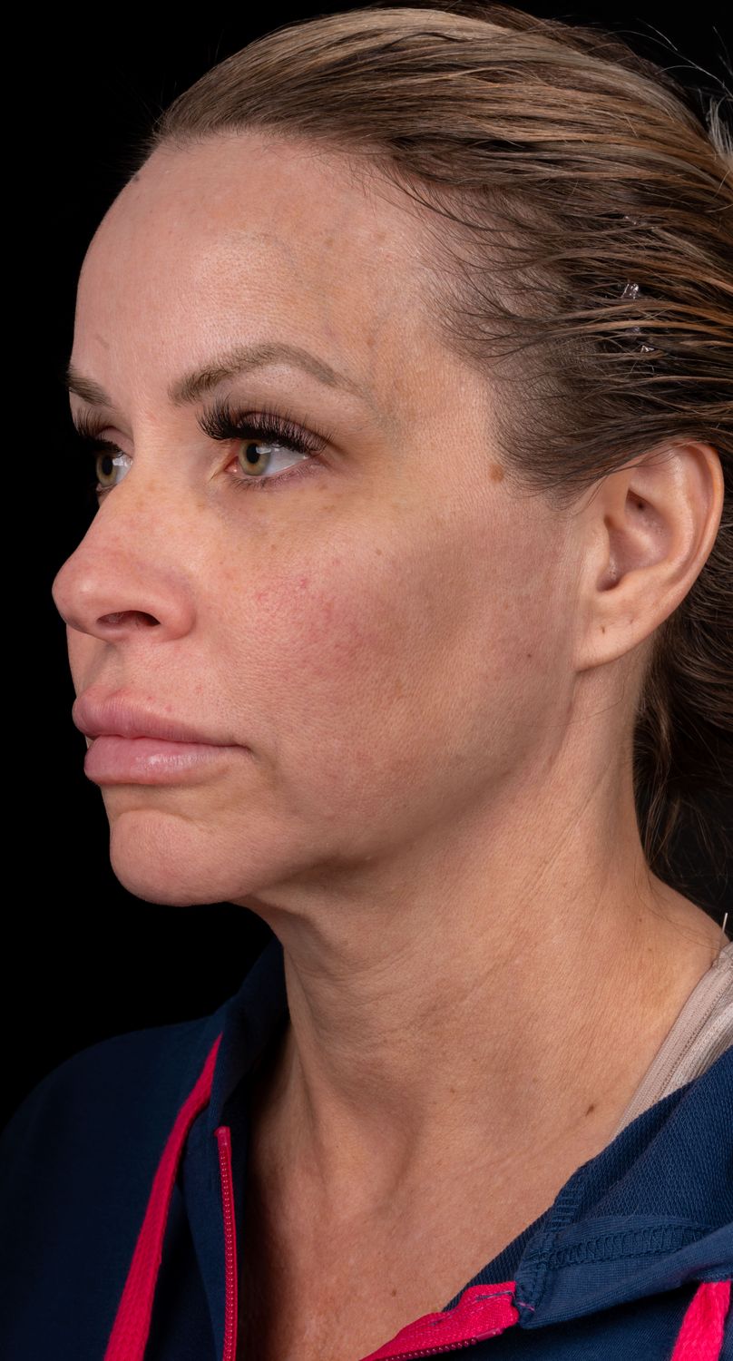 Neck Lift Before & After