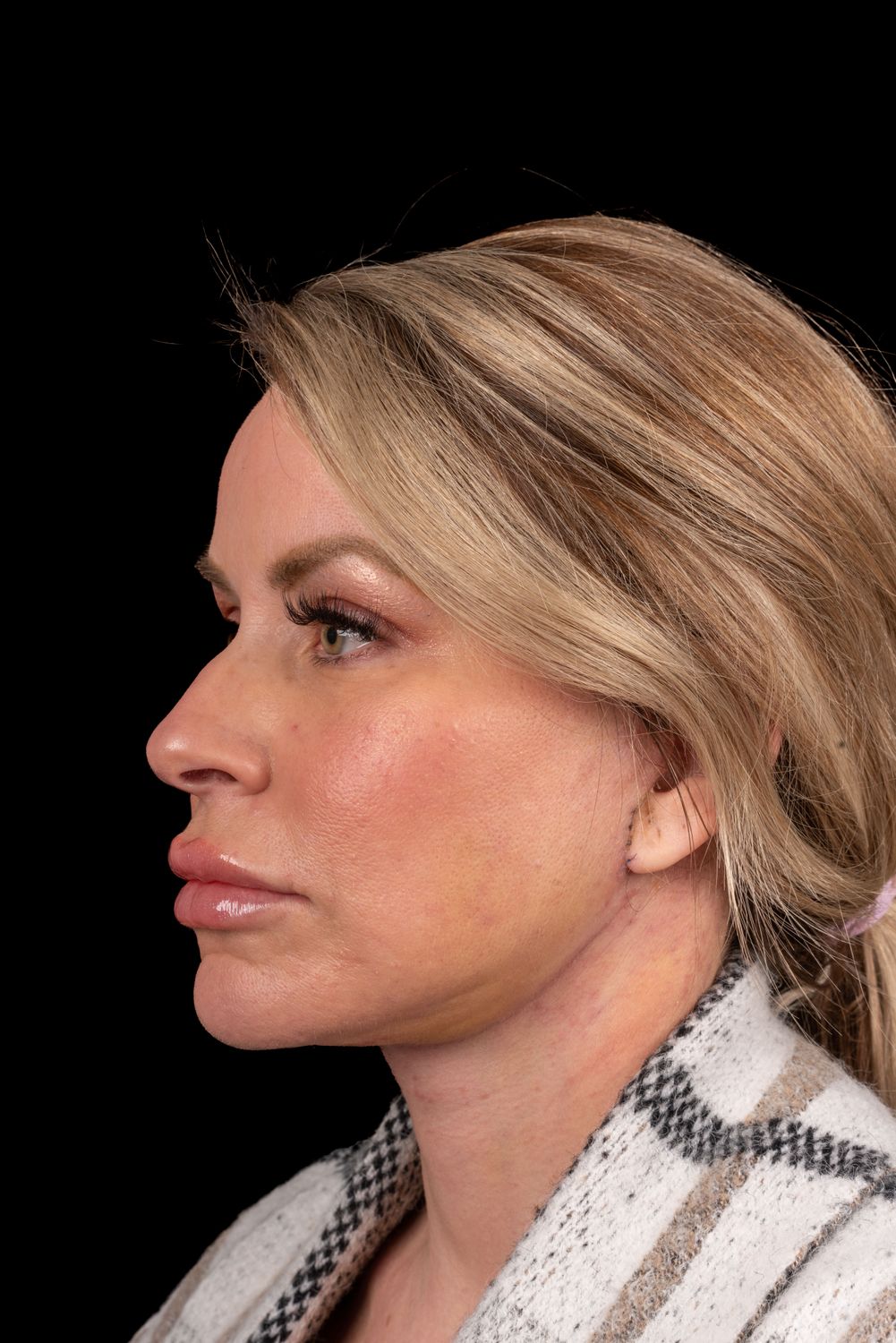 Neck Lift Before & After