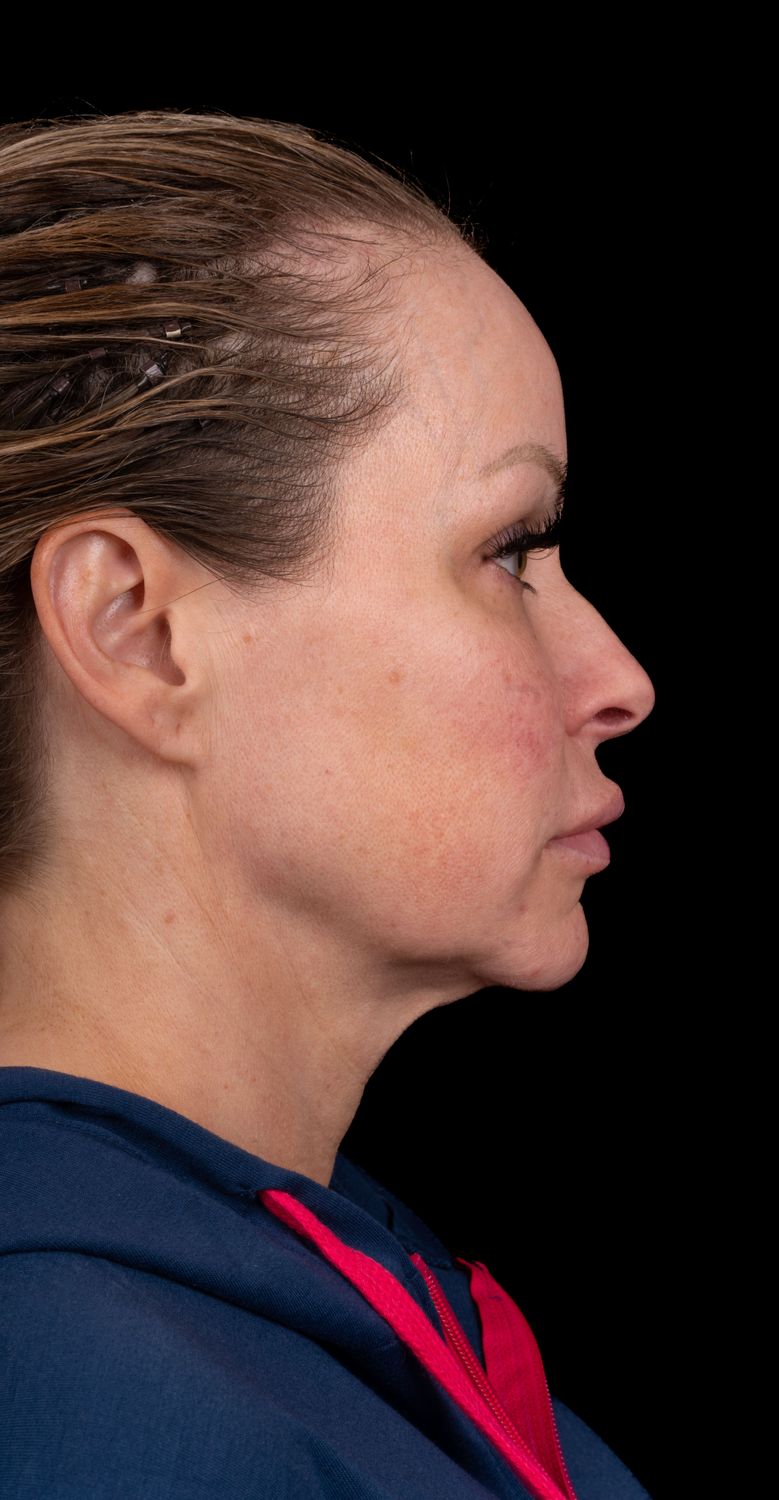 Neck Lift Before & After