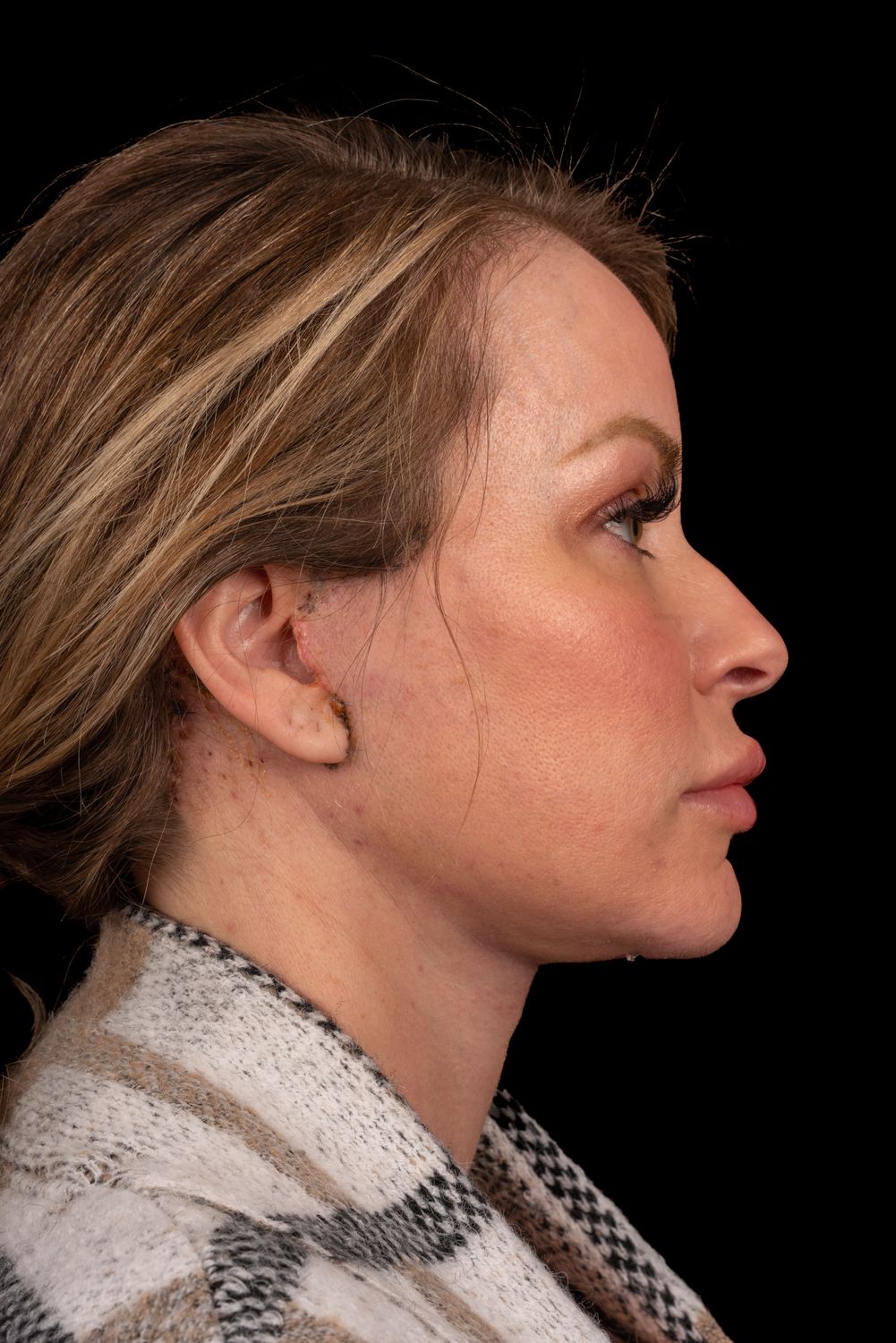 Neck Lift Before & After