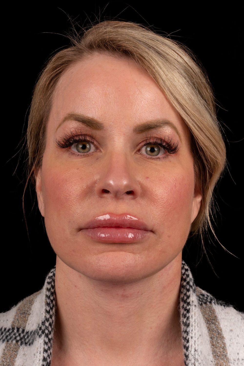 Neck Lift Before & After