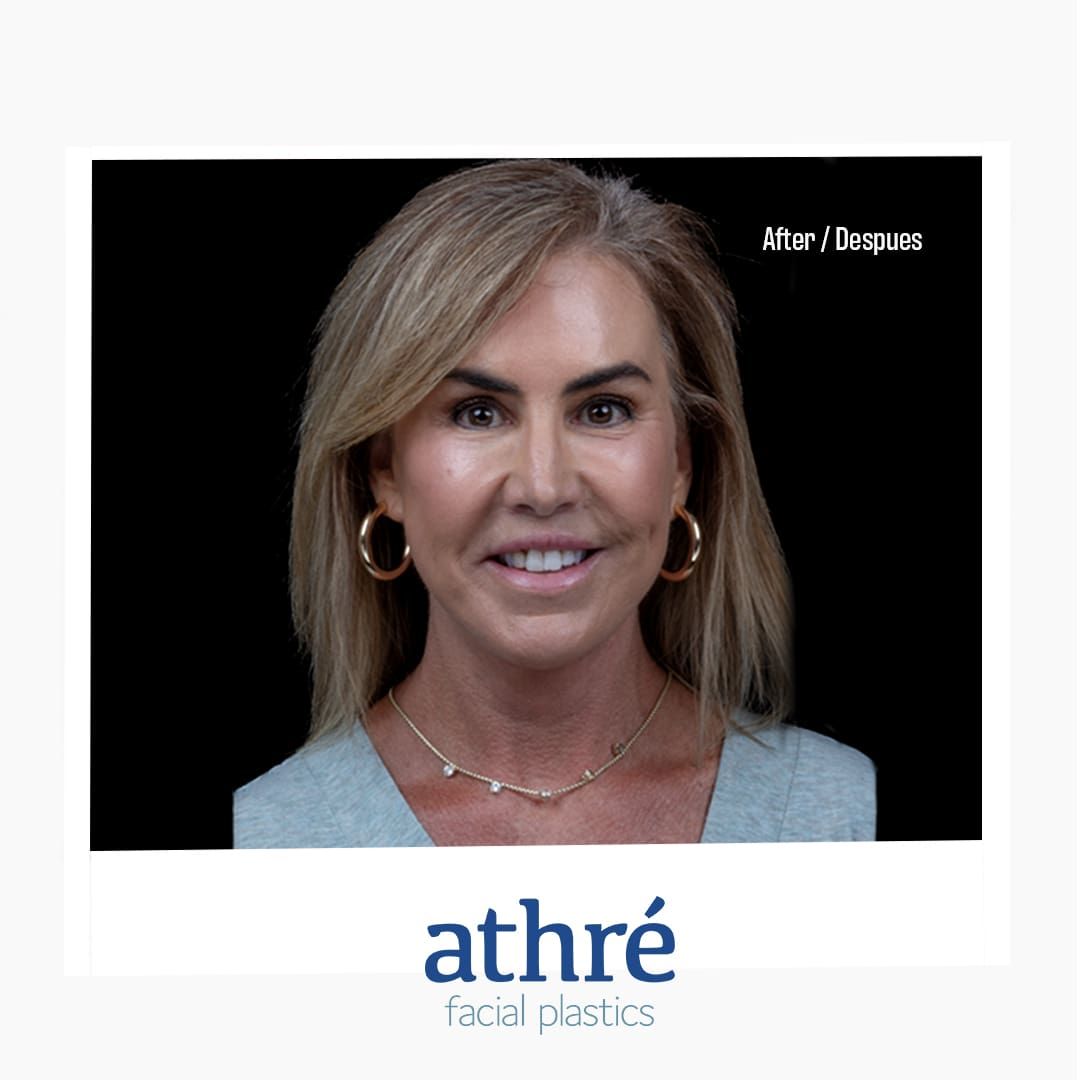 Neck Lift Before & After