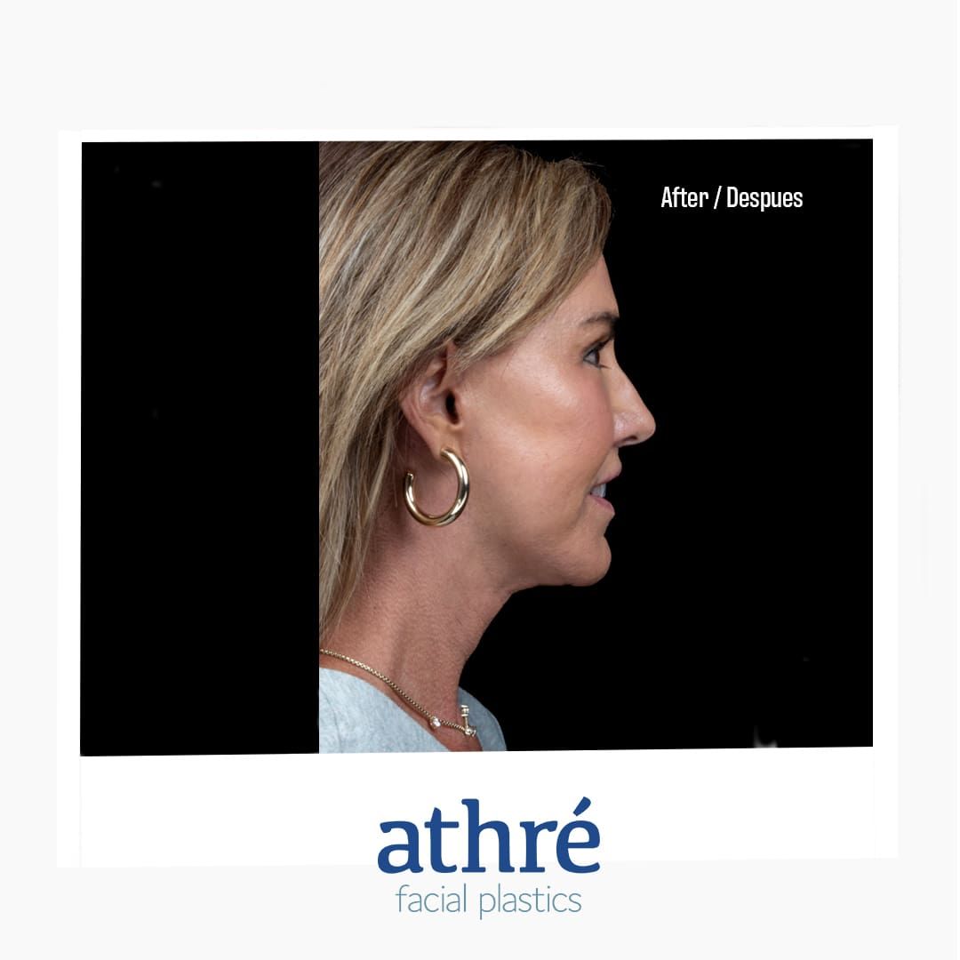 Neck Lift Before & After