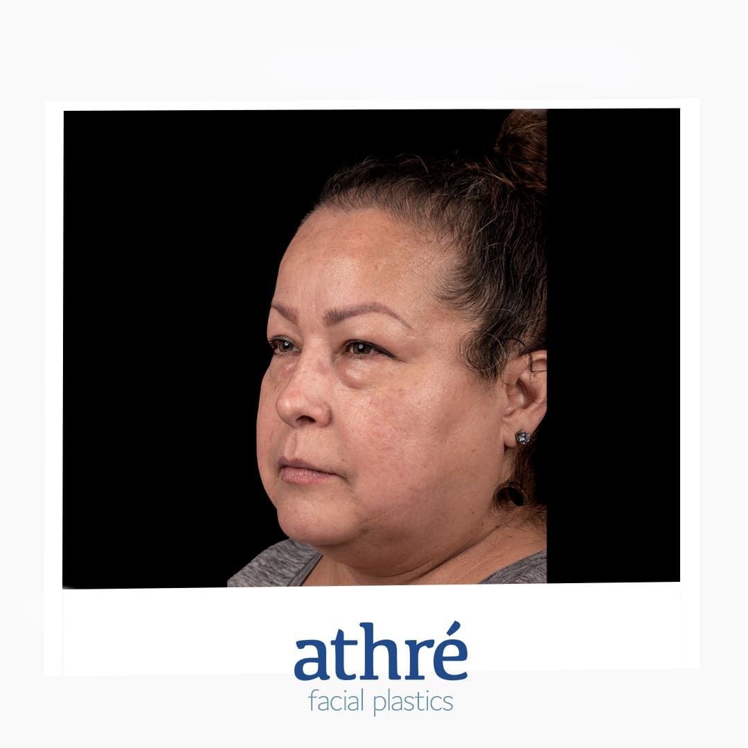 Neck Lift Before & After