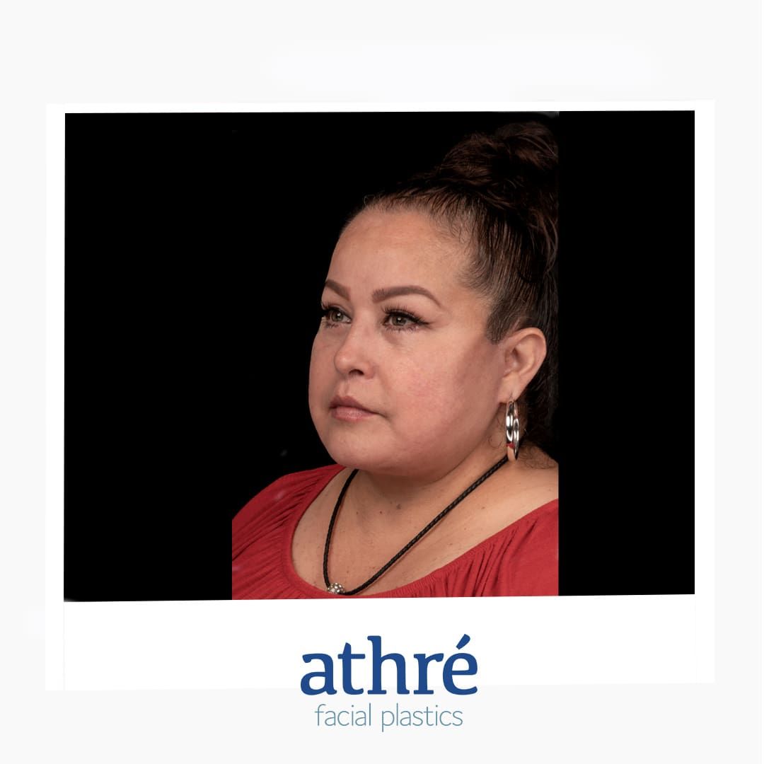 Neck Lift Before & After