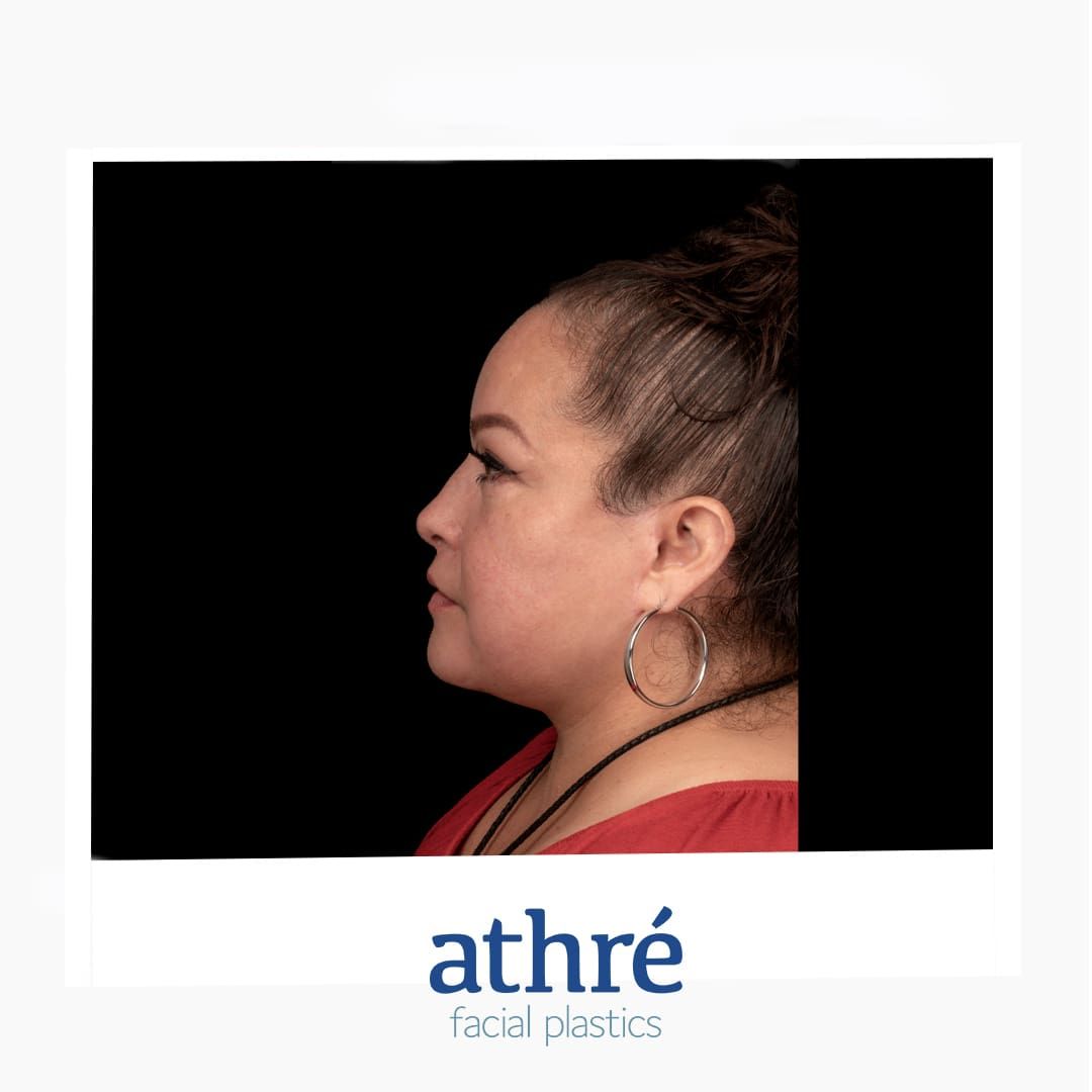 Neck Lift Before & After