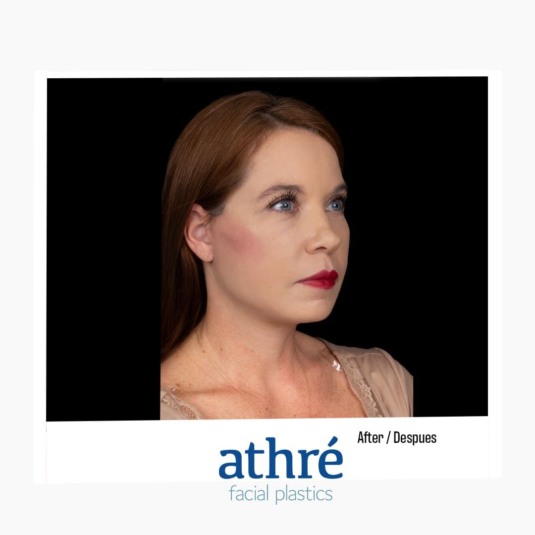 Neck Lift Before & After