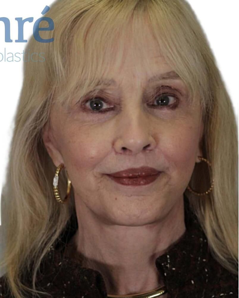 Under Eye Filler Before & After