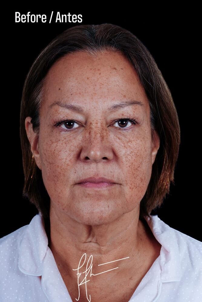 Under Eye Filler Before & After