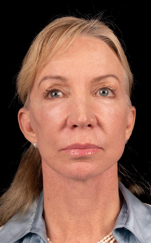 Under Eye Filler Before & After