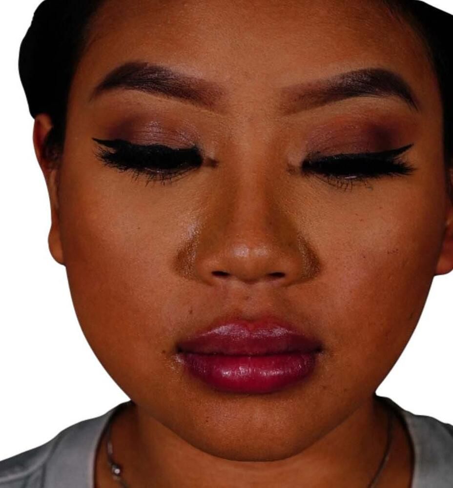 Restylane Before & After