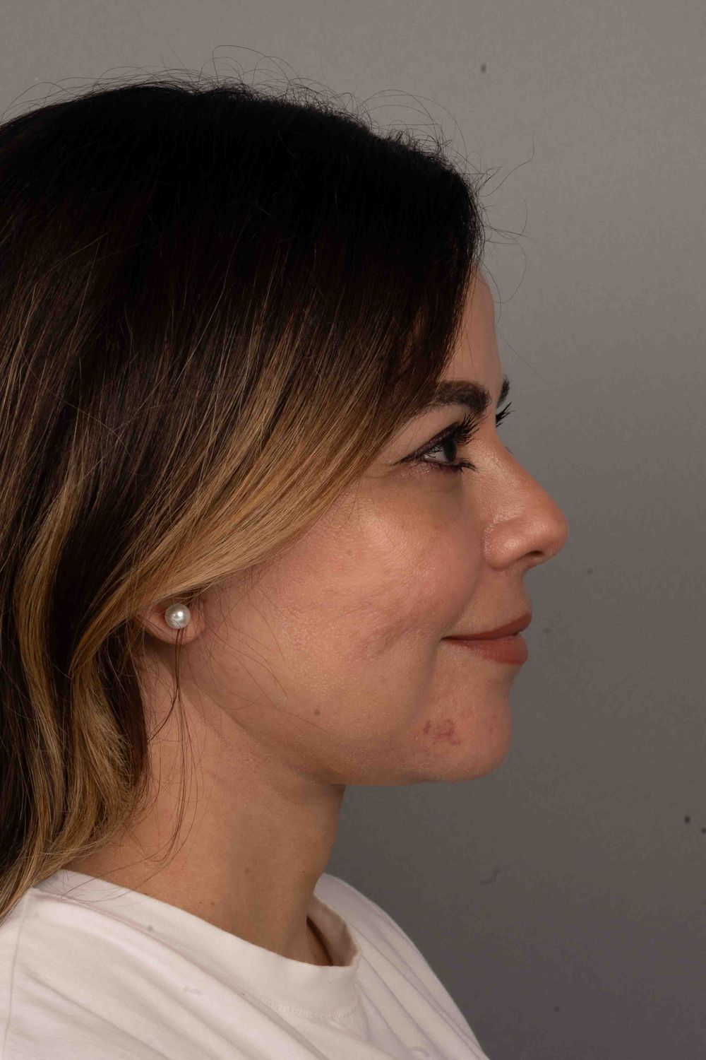 Facelift Before & After