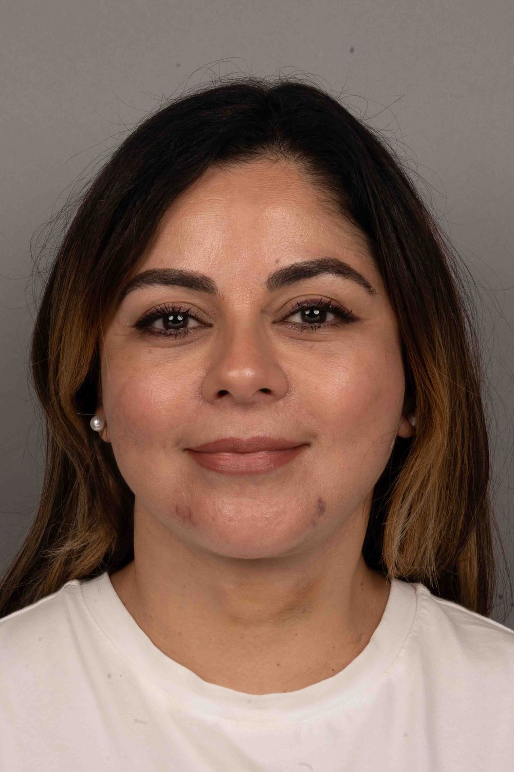 Facelift Before & After