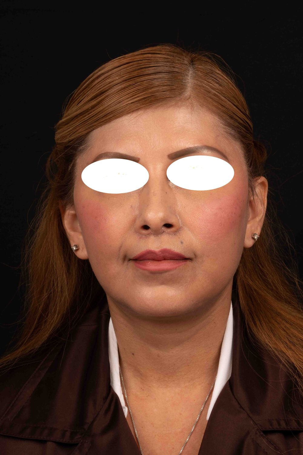 Facelift Before & After