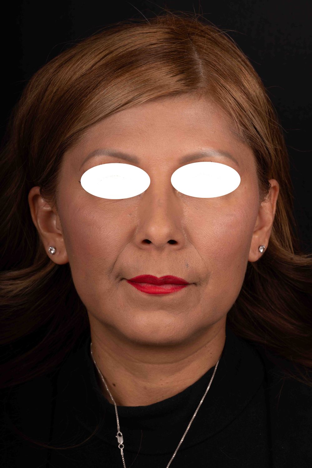 Facelift Before & After