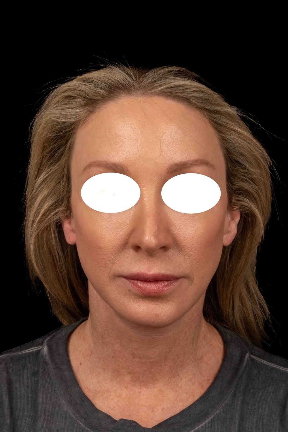 Facelift Before & After