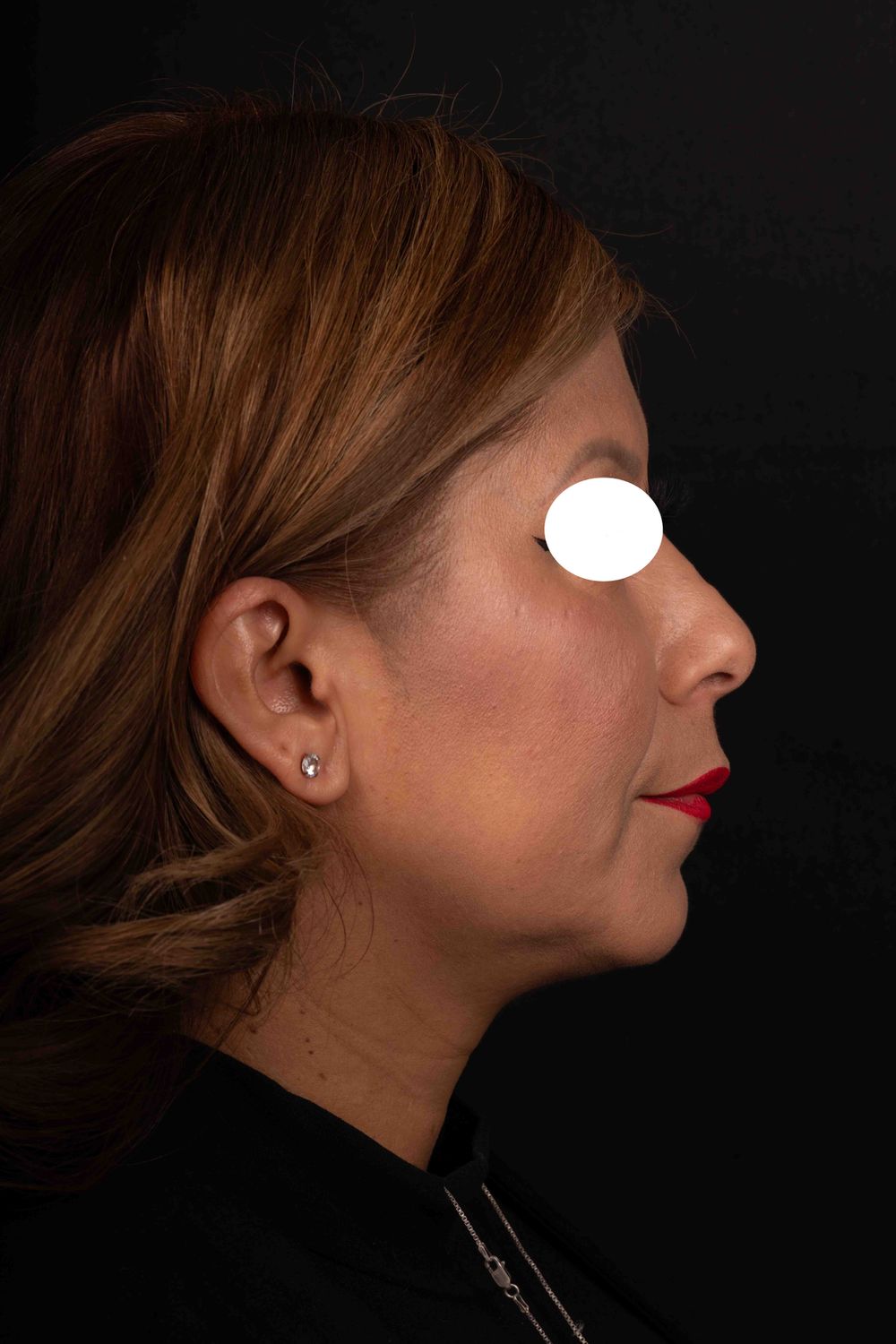 Facelift Before & After