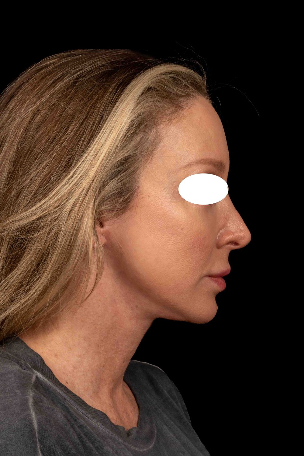 Facelift Before & After