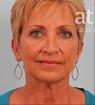 Facelift Before & After