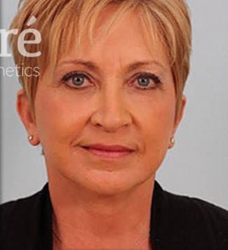 Facelift Before & After