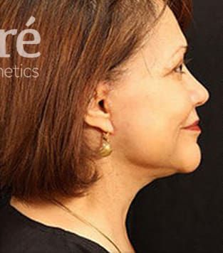 Facelift Before & After