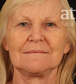 Facelift Before & After