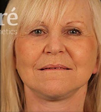 Facelift Before & After